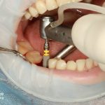 implant02 blog dr fotovvat