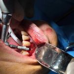 implant04 blog dr fotovvat